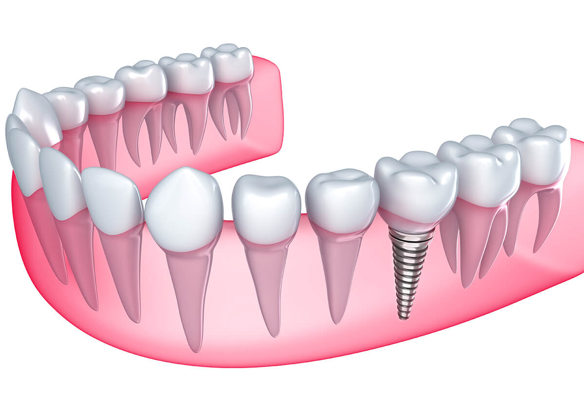 Dental Implants for Missing Teeth in New York Area
