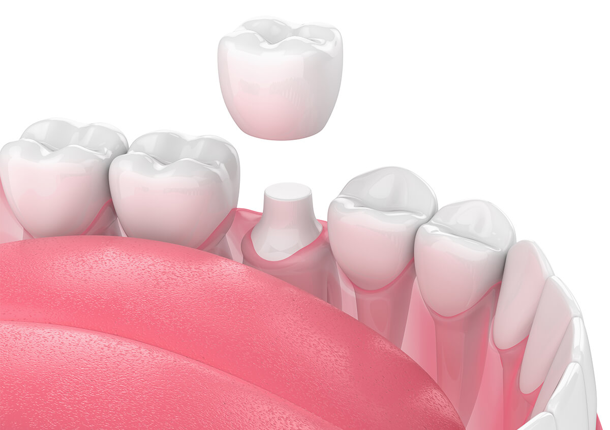 Dental Crowns in New York NY Area