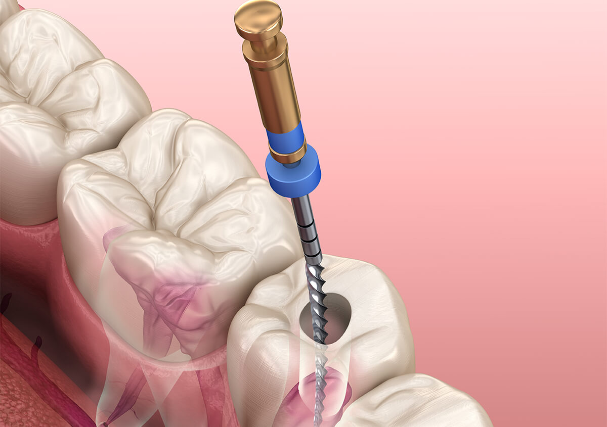 Root Canal Dentist in New York NY Area