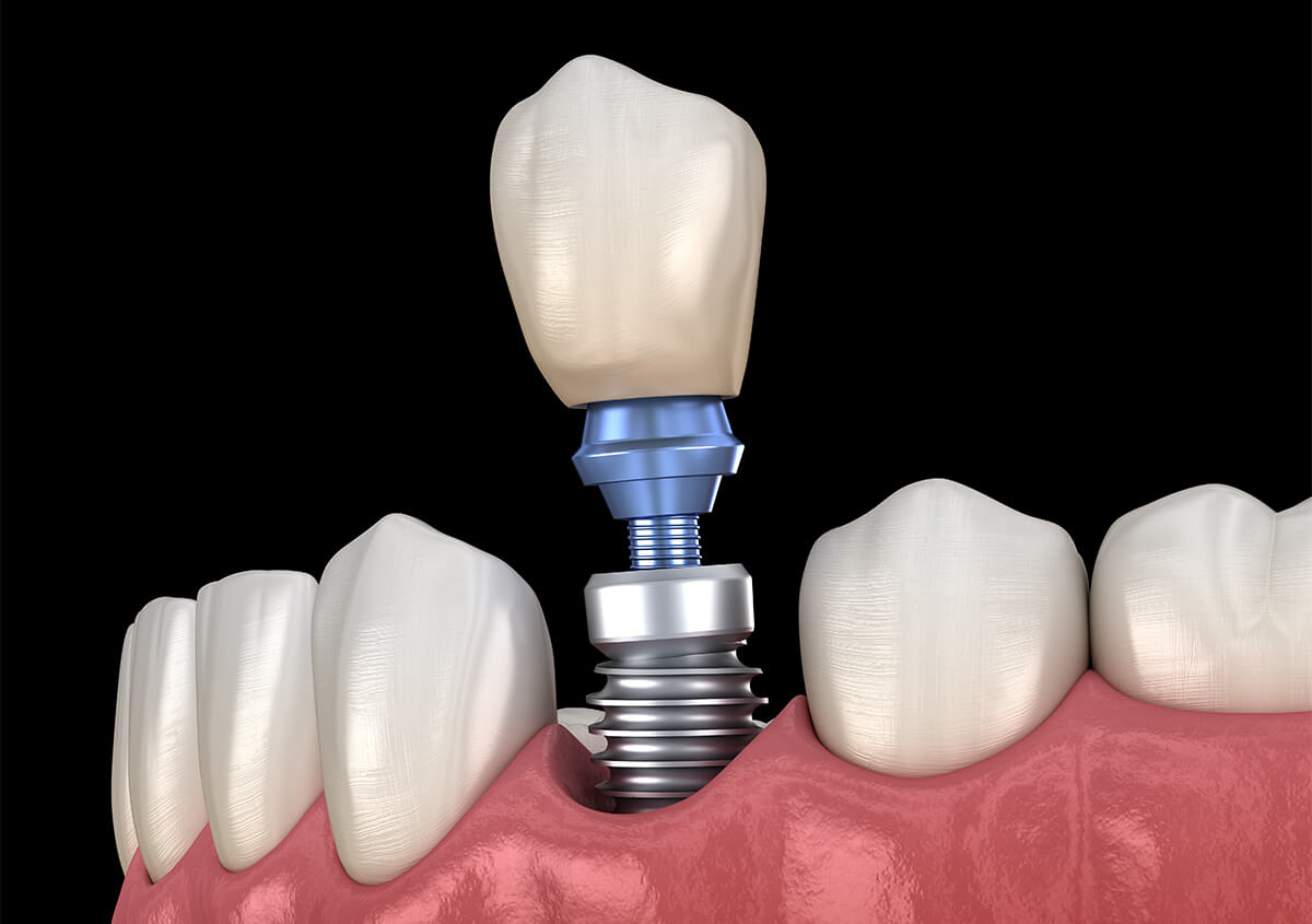 Teeth Implants Dentist in New York NY Area