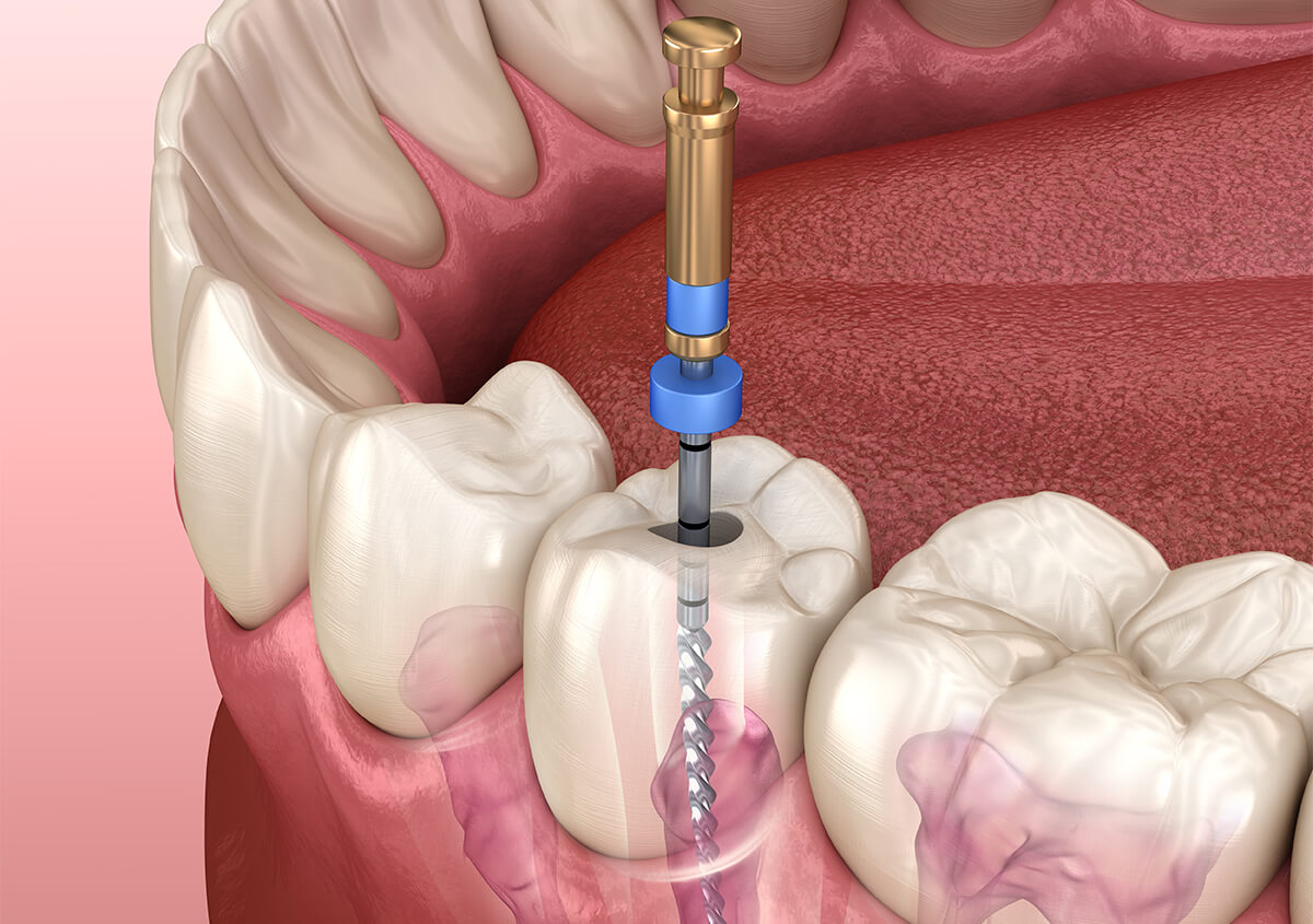 Root Canals Treatment in New York Area