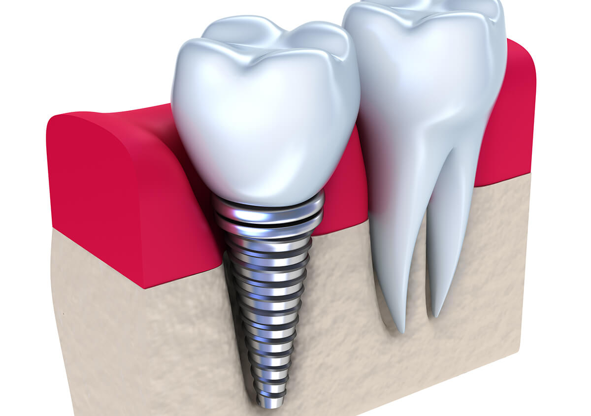 Importance of Dental Implants in New York Area