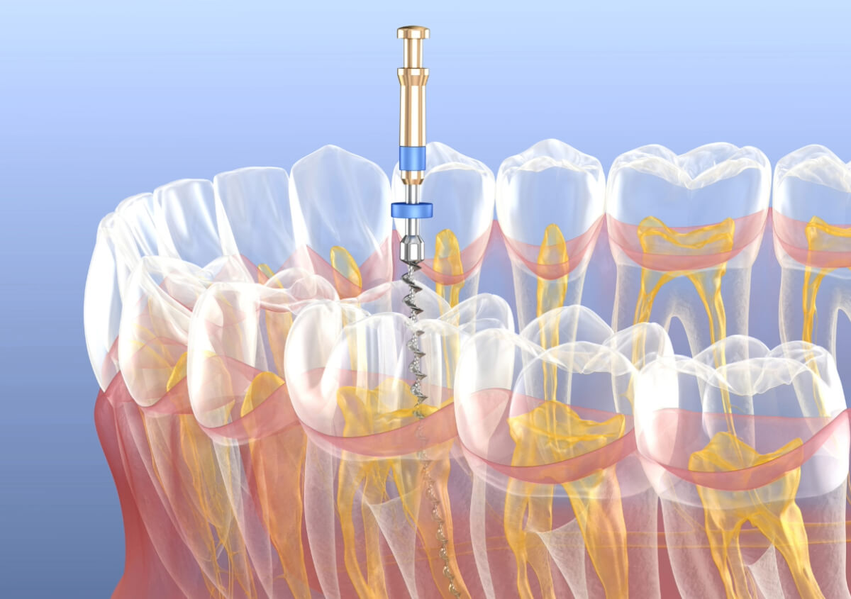 Dental Root Canal Procedure in New York NY area