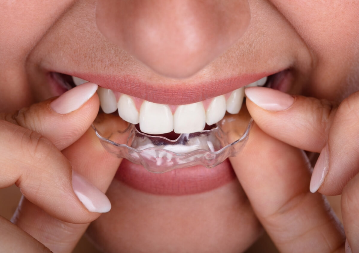 Invisalign Teeth Straightening in New York NY area