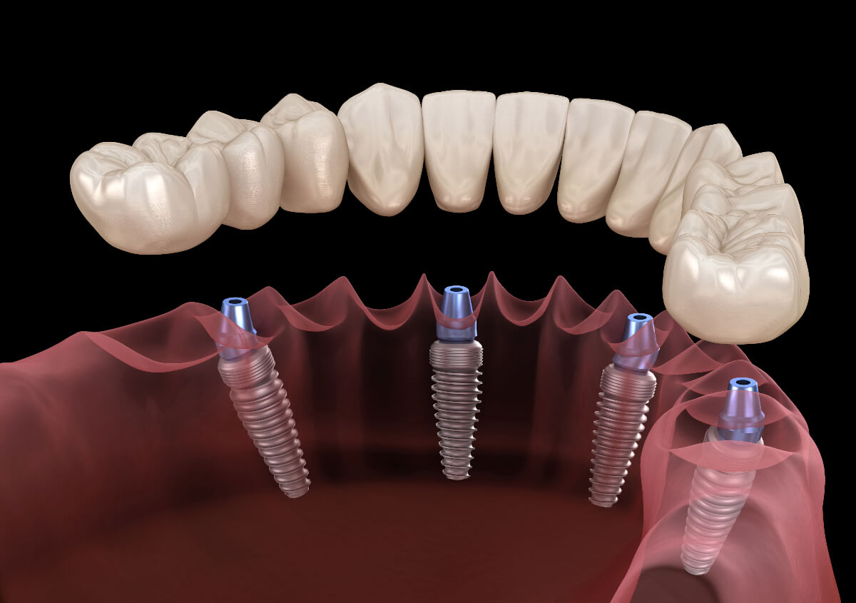Dental Implants in New York NY area